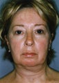 Liposuction - Lower Face - Lower Eyelid - Upper Neck