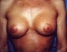 Female patient who underwent a breast reconstruction 