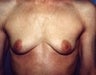 Female patient who underwent a breast reconstruction 