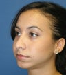 Rhinoplasty