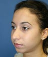 Rhinoplasty