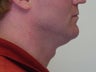 Liposuction