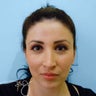 Otoplasty 
