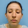 Otoplasty 