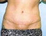 38 year old Female underwent tummy tuck and minor liposuction