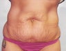 38 year old Female underwent tummy tuck and minor liposuction