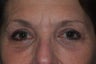 Eyelid Surgery