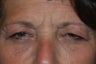 Eyelid Surgery
