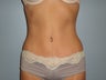 Tummy Tuck