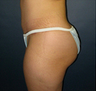 Butt Augmentation