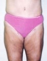 Female patient who underwent surgery for major weight loss 