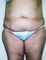 Female patient who underwent surgery for major weight loss 