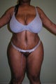Tummy Tuck with Brazilian Butt Lift