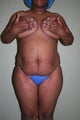 Tummy Tuck with Brazilian Butt Lift