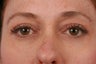 Eyelid Surgery