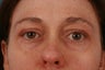 Eyelid Surgery
