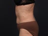 Liposuction Abdomen, Flanks, Inner & Outer Thighs
