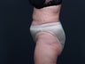 Liposuction Abdomen, Flanks, Inner & Outer Thighs