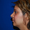 Revision Rhinoplasty