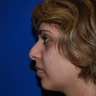 Revision Rhinoplasty