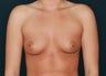 Breast Augmentation