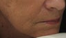 Marionette Line after Treatment with Juvederm Ultra Plus Injection gel