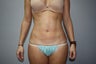 Liposuction