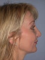 Neck Lift