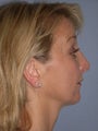 Neck Lift