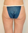 Power-Assisted Liposuction