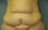 Tummy Tuck