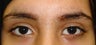 Eyelid Surgery