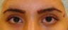 Eyelid Surgery