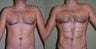 Abdominal etching along with Brazilian Butt Lift