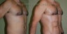 Abdominal etching along with Brazilian Butt Lift
