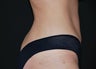 Abdominoplasty