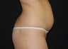 Abdominoplasty