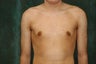 Male Breast Reduction