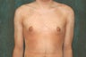 Male Breast Reduction