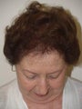 Female Hair Transplant 1450 Grafts
