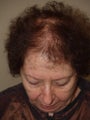 Female Hair Transplant 1450 Grafts