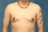 Male Breast Reduction