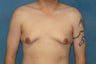 Male Breast Reduction