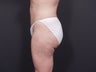 Liposuction Abdomen & Flanks