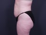 Liposuction Abdomen & Flanks