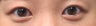Bilateral Asian Eyelid Surgery