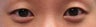 Bilateral Asian Eyelid Surgery