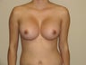 425 cc saline breast implants