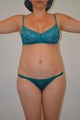 VASER Hi-Definition Female Abdomen and Flanks
