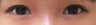 Bilateral Asian Eyelid Surgery